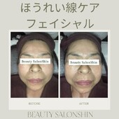 【フェイシャル】ビフォーアフター③|ビューティーサロンshin