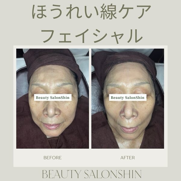 【フェイシャル】ビフォーアフター④|ビューティーサロンshin