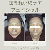 【フェイシャル】ビフォーアフター④|ビューティーサロンshin