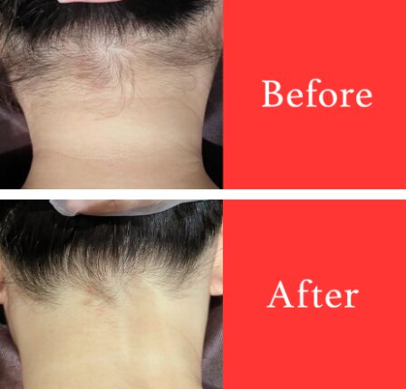 【脱毛】ビフォーアフター①|ビューティーサロンshin