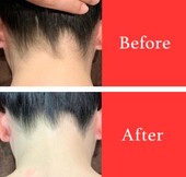 【脱毛】ビフォーアフター②|ビューティーサロンshin