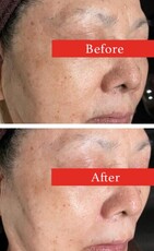 【フェイシャル】ビフォーアフター⑤|ビューティーサロンshin