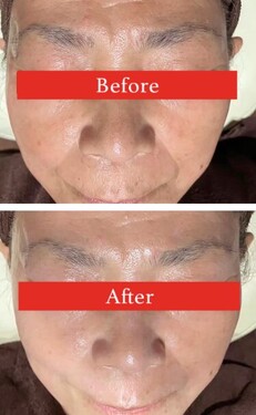 【フェイシャル】ビフォーアフター⑥|ビューティーサロンshin