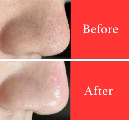 【小鼻黒ずみケア】ビフォーアフター①|ビューティーサロンshin