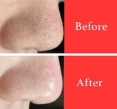 【小鼻黒ずみケア】ビフォーアフター①|ビューティーサロンshin