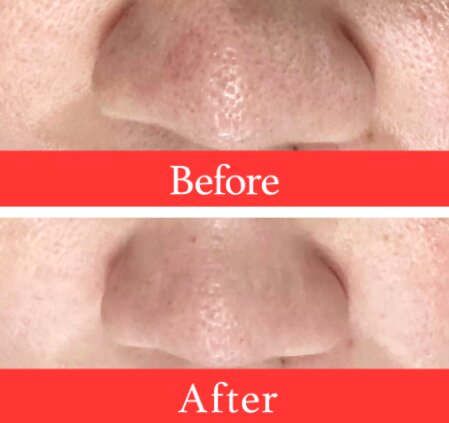【小鼻黒ずみケア】ビフォーアフター②|ビューティーサロンshin