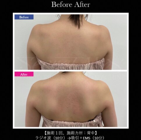【痩身】ビフォーアフター①|ビューティーサロンshin