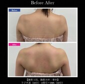 【痩身】ビフォーアフター①|ビューティーサロンshin