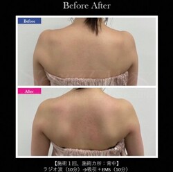 【痩身】ビフォーアフター①|ビューティーサロンshin
