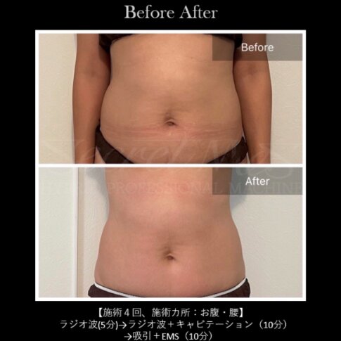 【痩身】ビフォーアフター②|ビューティーサロンshin