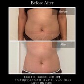 【痩身】ビフォーアフター②|ビューティーサロンshin
