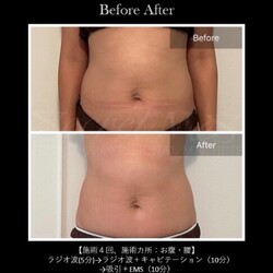 【痩身】ビフォーアフター②|ビューティーサロンshin