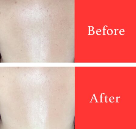 【美白ケア】ビフォーアフター①|ビューティーサロンshin