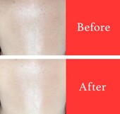 【美白ケア】ビフォーアフター①|ビューティーサロンshin