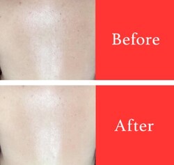 【美白ケア】ビフォーアフター①|ビューティーサロンshin