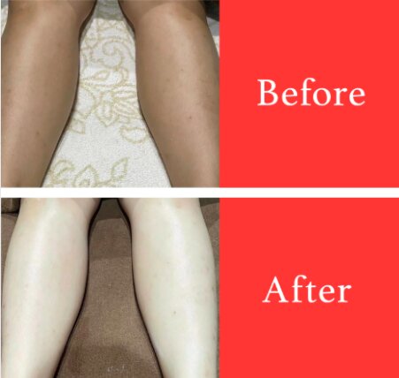 【美白ケア】ビフォーアフター②|ビューティーサロンshin