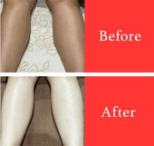 【美白ケア】ビフォーアフター②|ビューティーサロンshin