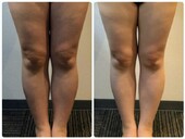  美脚ケア/太ももスッキリ|Beautysalon REFLET