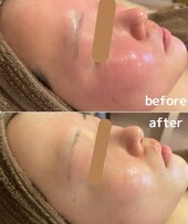 【ハーブピーリング】ビフォーアフター①|will B...?