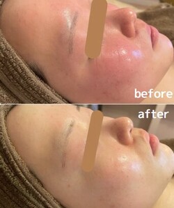 【ハーブピーリング】ビフォーアフター①|will B...?