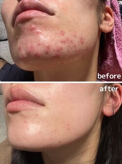 【ハーブピーリング】ビフォーアフター②|will B...?