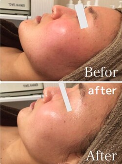 【ハーブピーリング】ビフォーアフター③|will B...?