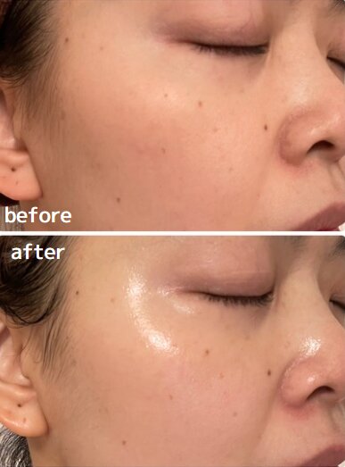【ハーブピーリング】ビフォーアフター④|will B...?