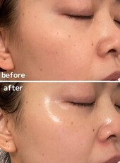 【ハーブピーリング】ビフォーアフター④|will B...?