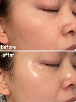 【ハーブピーリング】ビフォーアフター④|will B...?