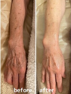 【ハーブピーリング】ビフォーアフター⑤|will B...?