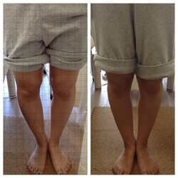 O脚矯正