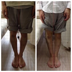 膝下のねじれ解消