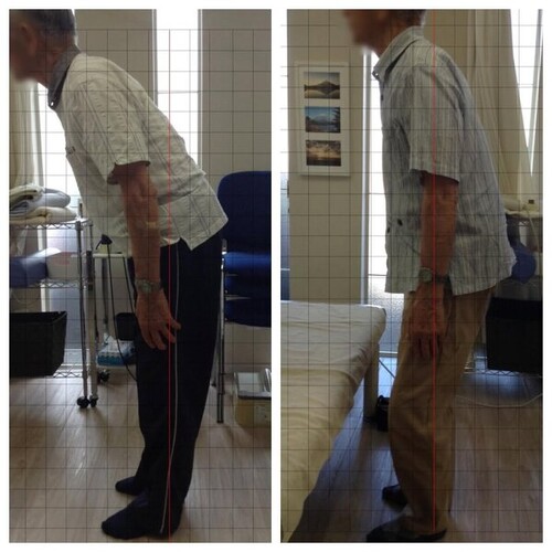 約2週間、5回の施術での比較