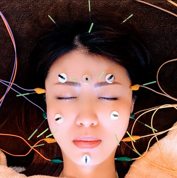 【お悩み別美容鍼】オーダーメイド美容鍼灸|さつき鍼灸整骨院 鍼灸フェイシャルサロンさつき