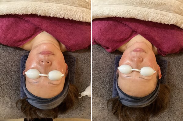 エイジングケアBBL体験☆|まつげサロン アイビー