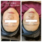 エイジングケアBBL体験★|まつげサロン アイビー