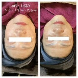 エイジングケアBBL体験★|まつげサロン アイビー