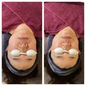 エイジングケア！BBL体験|まつげサロン アイビー