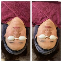 エイジングケア！BBL体験|まつげサロン アイビー