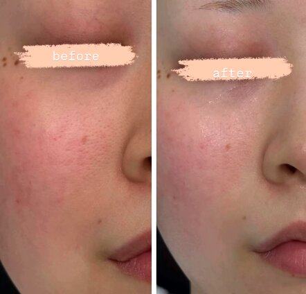 【水エステ】before/after①|おしゃれサロンささ