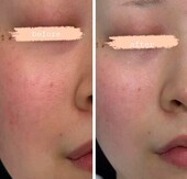 【水エステ】before/after①|おしゃれサロンささ