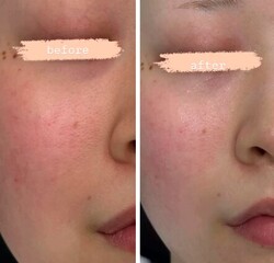 【水エステ】before/after①|おしゃれサロンささ