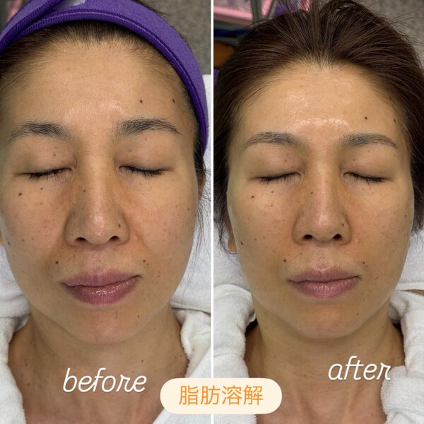 【脂肪溶解フェイシャル】before/after|おしゃれサロンささ