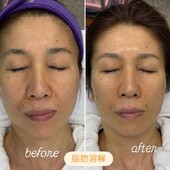 【脂肪溶解フェイシャル】before/after|おしゃれサロンささ