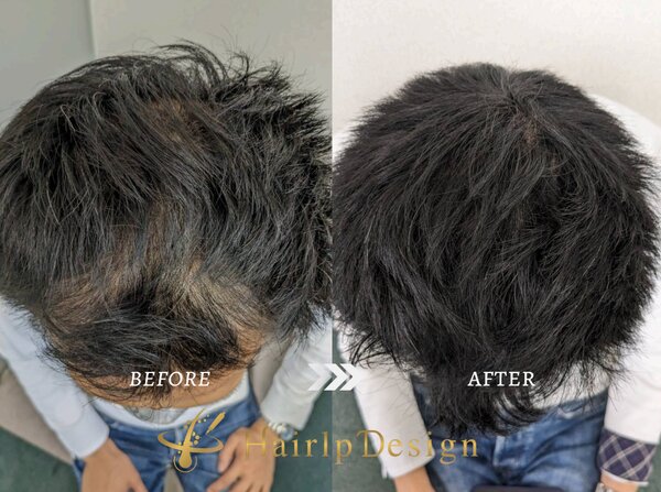 ヘアタトゥー（Before After）男性①|Perfect EYE