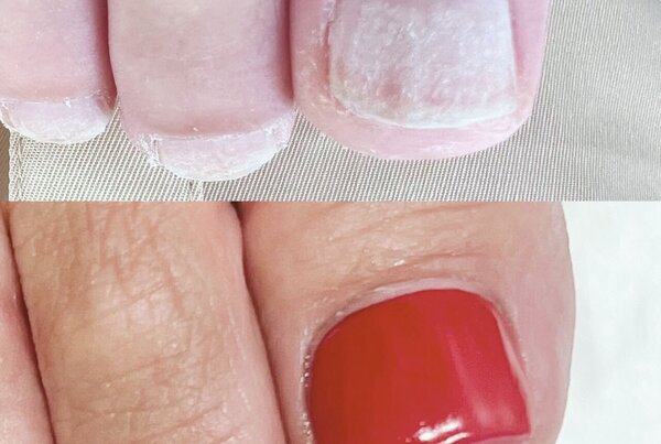 「フットケア＋爪形成＋足裏ケア」深爪や欠けた爪を形成し、美しい仕上がりになる爪形成です|Nail Salon Linda