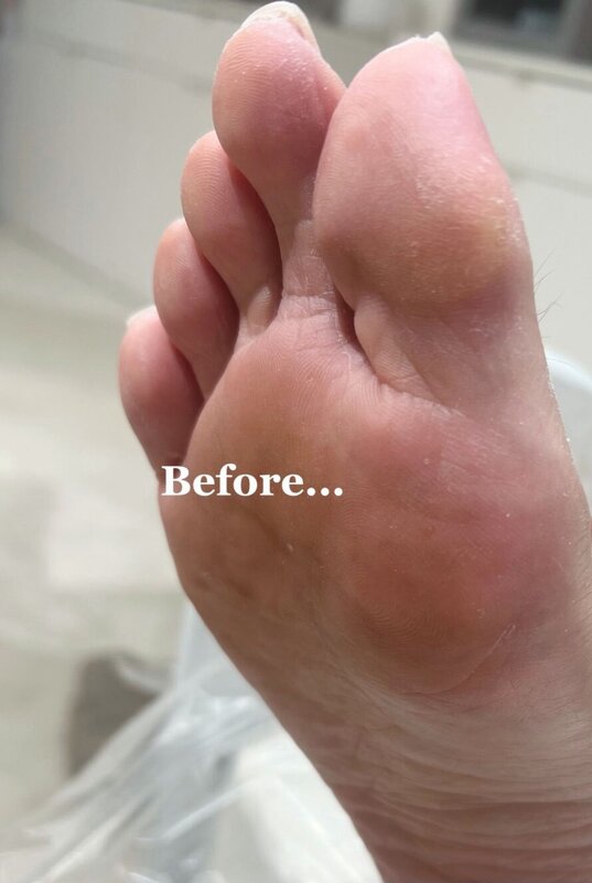 「フットケア」伸びすぎてしまい、どんどん巻き爪が進んでしまった爪先|Nail Salon Linda