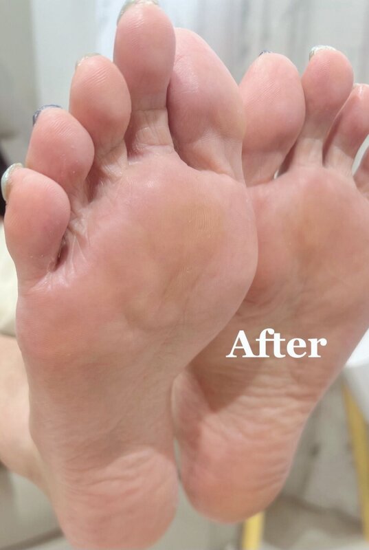 「フットケア」伸びすぎてしまい、どんどん巻き爪が進んでしまった爪先|Nail Salon Linda