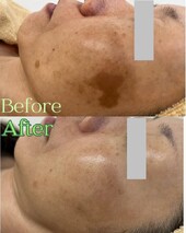 【肌質改善】before/after①|Apple. 宇都宮店【アップル】