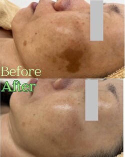 【肌質改善】before/after①|Apple. 宇都宮店【アップル】